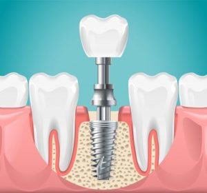 An illustration of an implant being placed into a jawbone 