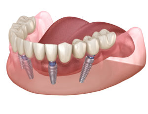 All-on-4 dental implants graphic 