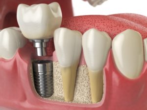 dental implants 3D illustration