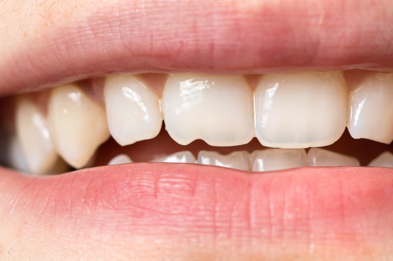 Close-up of a chipped tooth