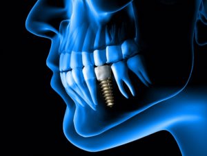 Digital image of a dental implant