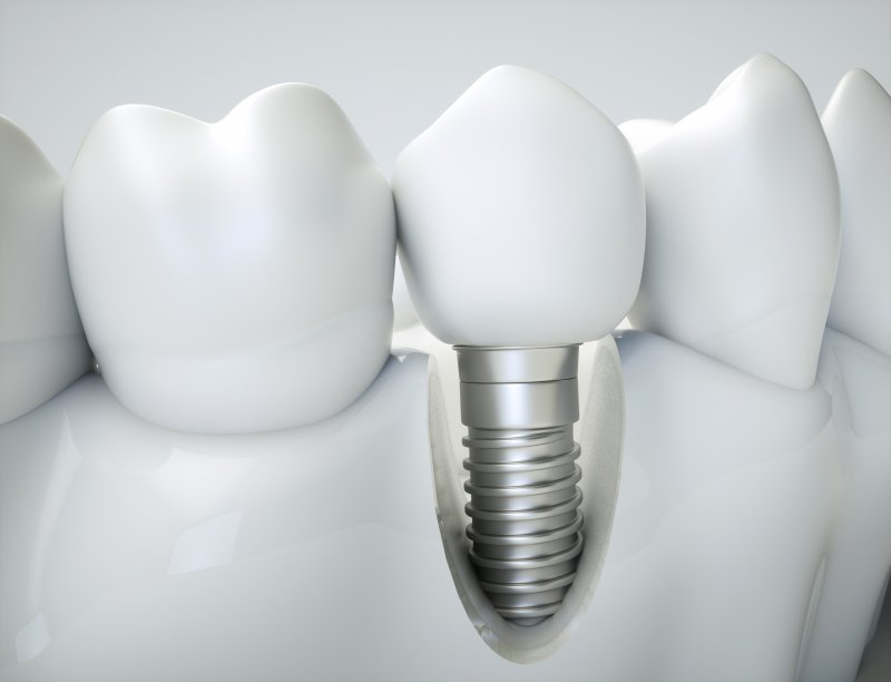 Diagram of a dental implant