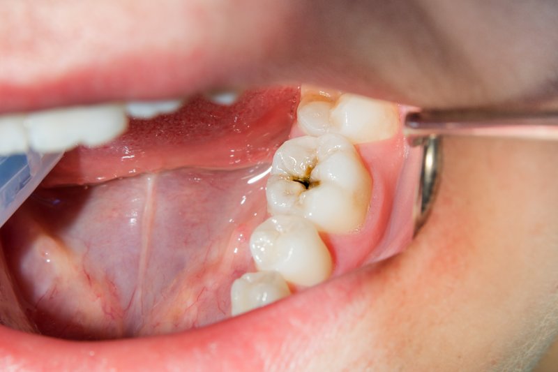 A closeup of teeth suffering from tooth decay