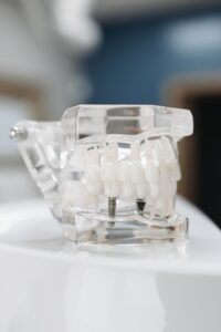 Dental model of implant supported bridge