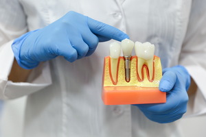 Dentist pointing to model of dental implants with gloved hands